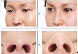 歪鼻矫正视频,从术前准备到术后恢复